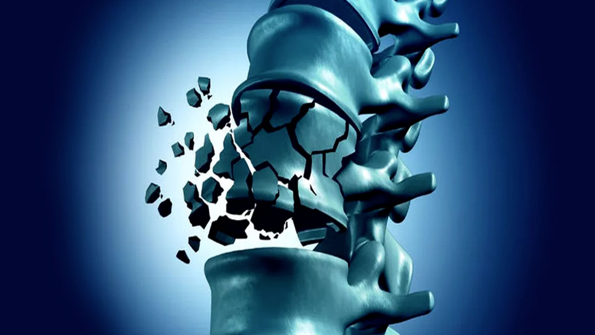 Le fratture vertebrali: Classificazione, diagnosi e principi di trattamento