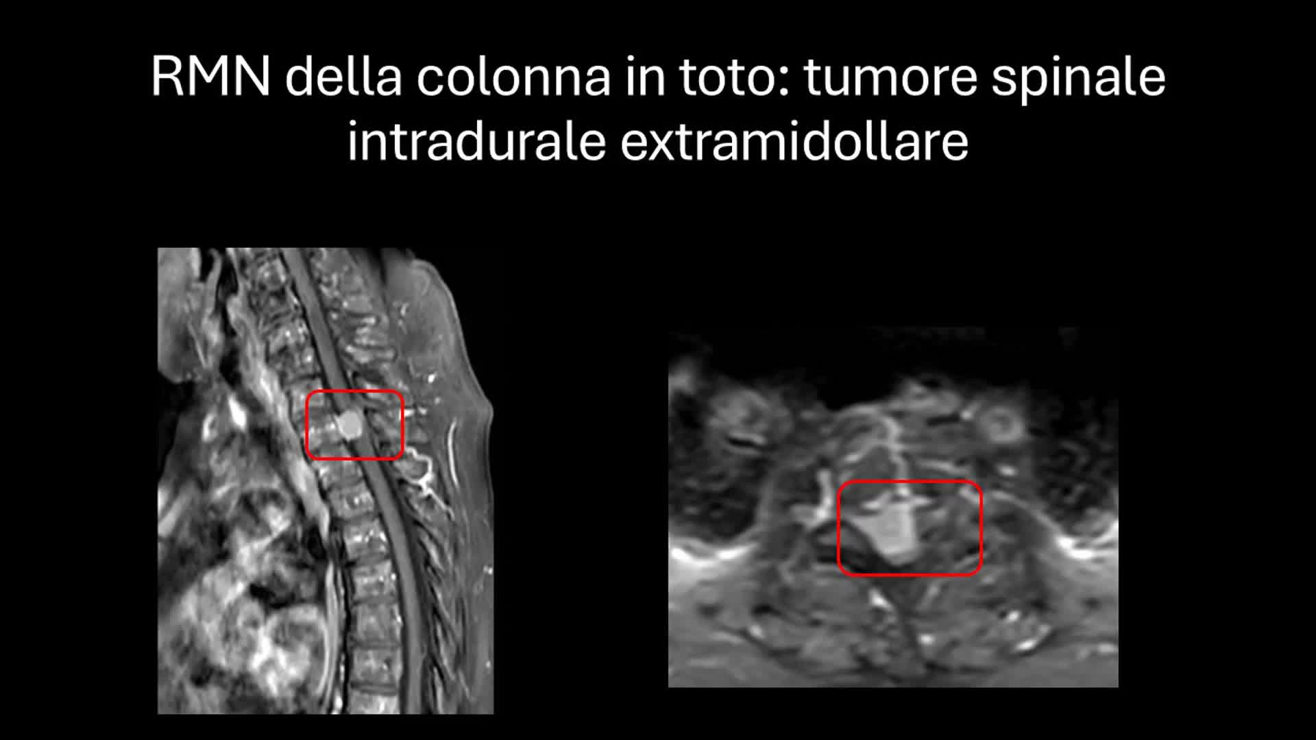 Meningioma T2-8