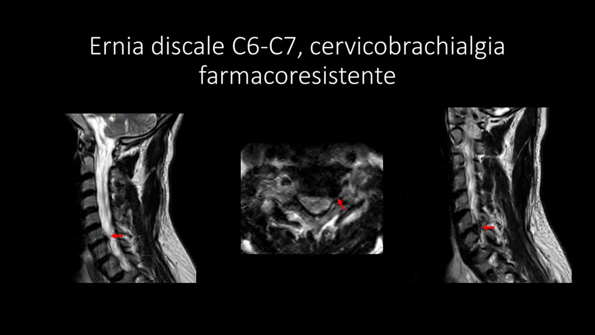 Ernia cervicale C6-C7-3