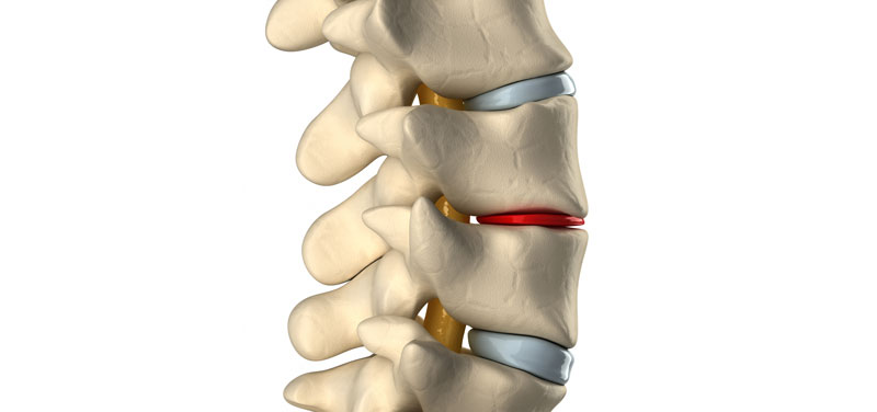 Discopatia-Degenerativa