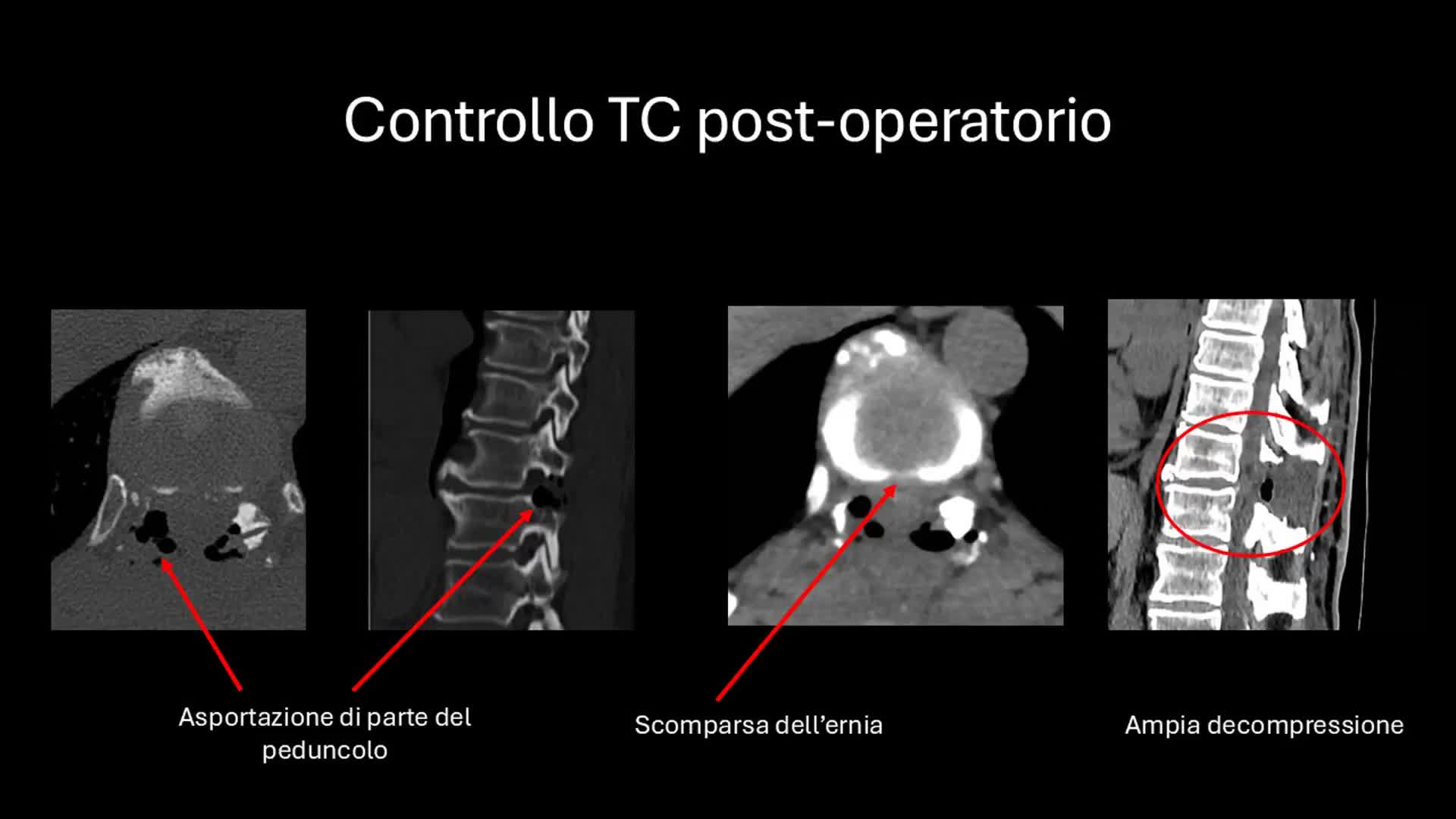 Ernia dorsale mediana D9-D10-5