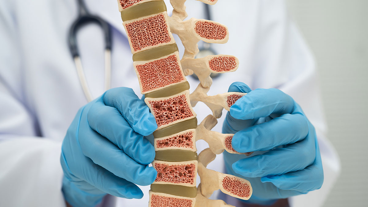 Stenosi Spinale Lombare: Sintomi, Diagnosi e Trattamento